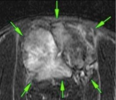 cancer fibrosarcoma gato