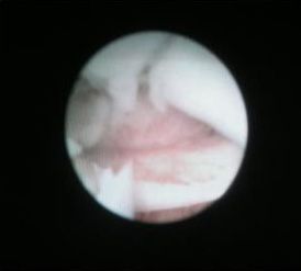 endoscopia