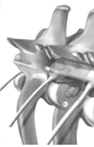 hernia discal