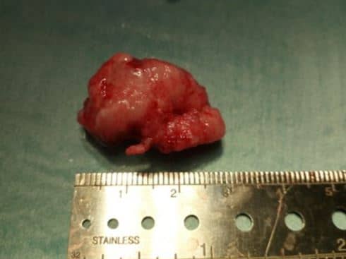 meningioma cerebral perro